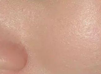 毛孔粗大如何治疗最好最快,如何治疗黑头和毛孔粗大