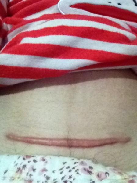 头胎剖宫产二胎疤痕妊娠几率,一胎剖腹产二胎瘢痕处妊娠的几率