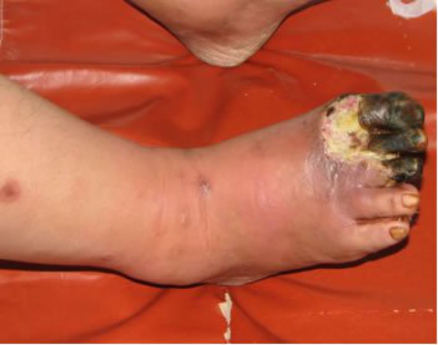 糖尿病下肢介入手术后注意事项,糖尿病下肢发凉怎么治疗