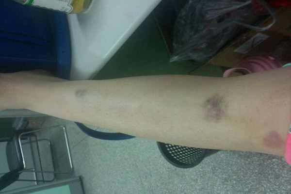 皮肤出现紫色瘀斑图片怎么治疗,手臂上出现瘀斑会有哪些疾病