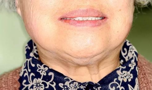 速看！刚刚发布大消息！8月起牙齿矫正、种植牙这10项费用全免！