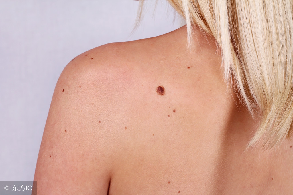 脸上有一颗痣很大怎么去除,脸上有痣看一下代表什么