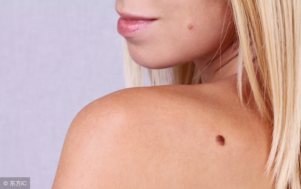 脸上有一颗痣很大怎么去除,脸上有痣看一下代表什么