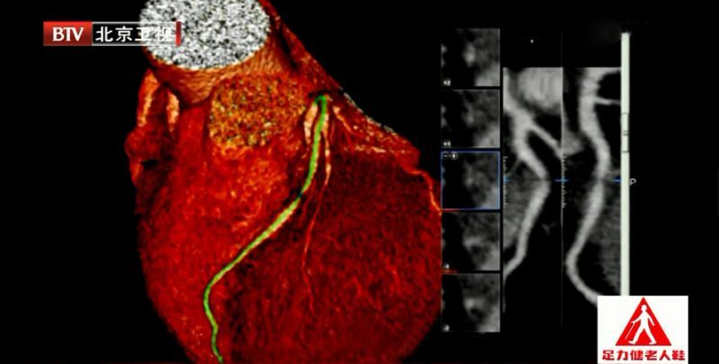 眼角血脂斑怎么消除,眼角长什么说明血脂高