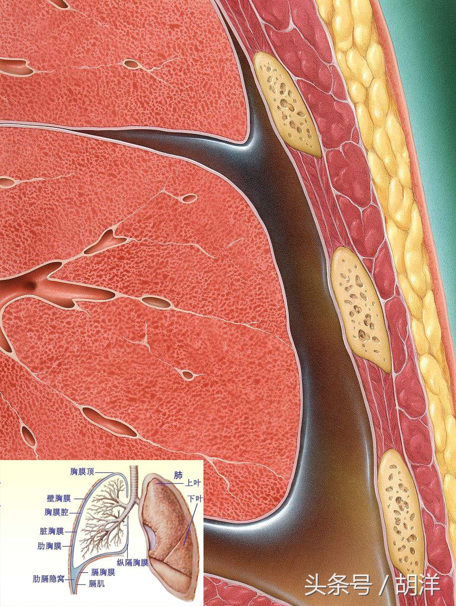 肝性胸腔积液症状怎么调理,肾脏引起的胸腔积液怎么治疗