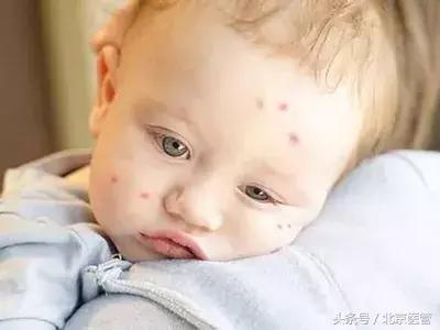 宝宝起红疙瘩怎么快速消除,宝宝红疙瘩擦什么药膏