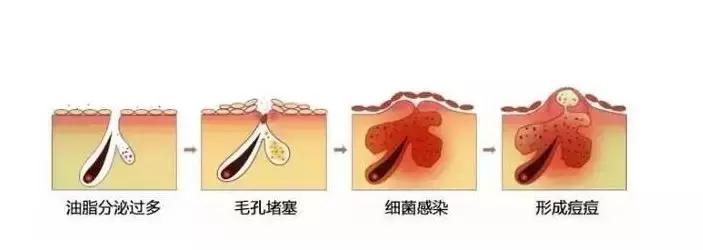 公认最好用的祛痘产品,一觉醒来长了好多痘痘怎么办