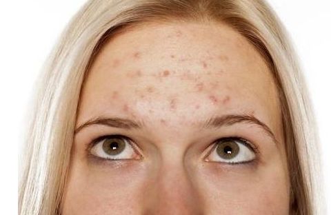 公认最好用的祛痘产品,一觉醒来长了好多痘痘怎么办