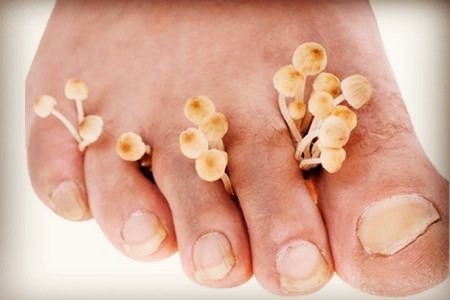 增厚型脚气治不好,脚气真的治不好吗