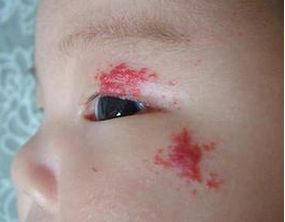 注意了身上长这5种痣特容易癌变,痣出现哪些变化是恶变的征兆