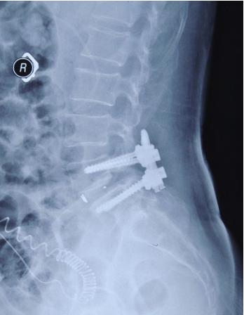 脊柱打6个钢钉手术需要多长时间,脊椎打钉子取出要做手术吗