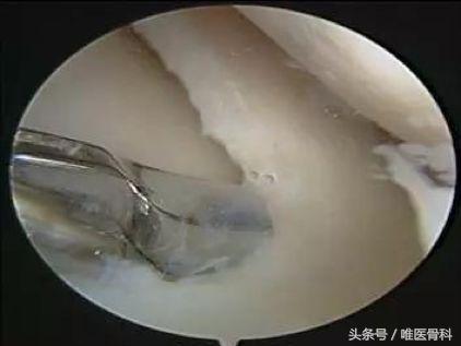 nba半月板损伤都是怎么恢复的,nba球星半月板损伤恢复比较好的