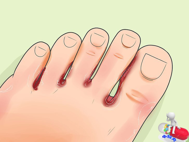 还在为脚臭而发愁吗,这些秘方帮您攻克顽固脚气