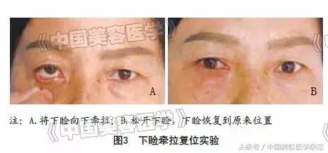 外眦悬吊固定视频操作方法,眼睑松弛矫正手术术前设计方案