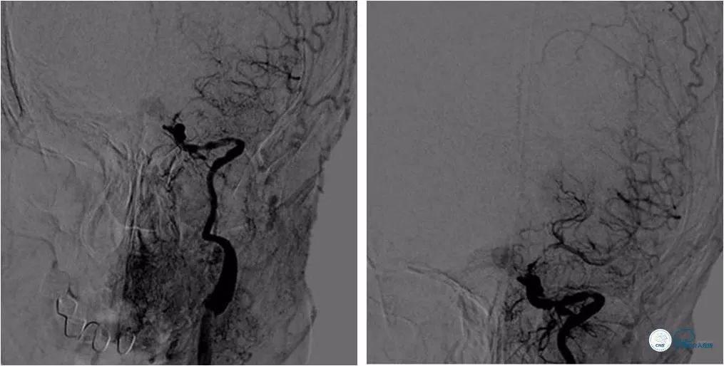 颈内动脉c5到c7段狭窄微创手术,天坛医院住院日记