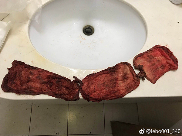 北大人民医院妇产,北大妇产科剖腹产