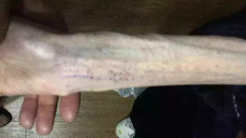 病态式减肥,病态减肥减到心理扭曲