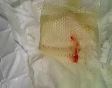 出生没几天的女婴尿布上有血，妈妈惊了！姥姥却很淡定