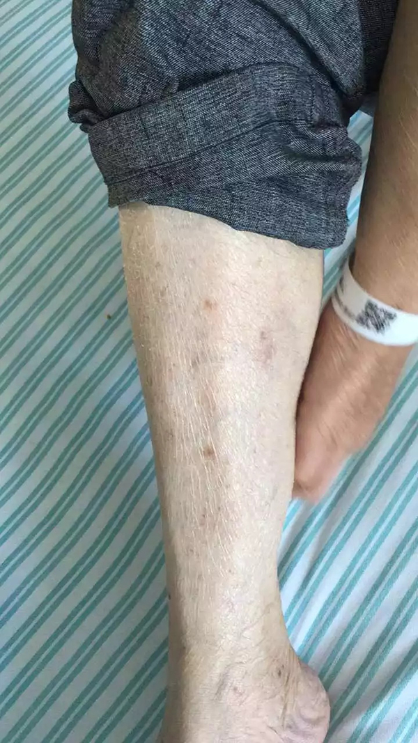 老人听信偏方乱投医吃错了药,大伯吃掉上百支皮炎平软膏