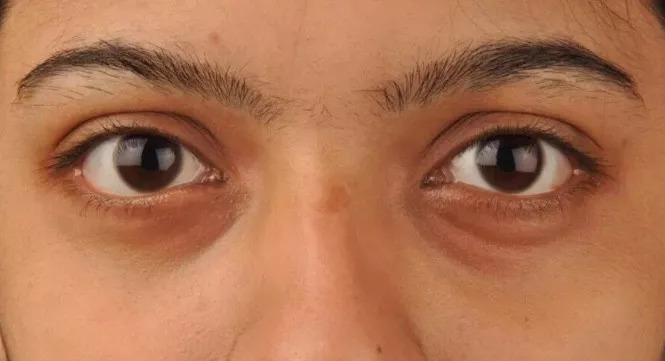 黑眼圈和眼袋总是消不掉怎么办,黑眼圈去不掉是因为没有对症下药