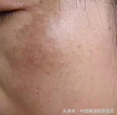 药物水光注射治疗*褐斑黄**对患者CK10、SOD及MDA表达水平的影响