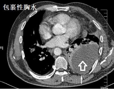 胸水抽了为什么还呼吸困难,胸水抽不出来了怎么回事