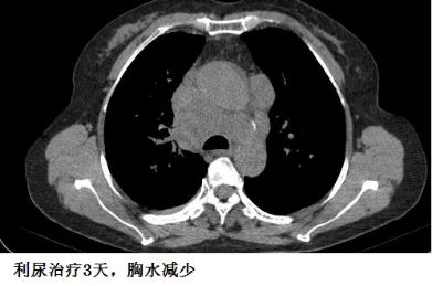 胸水为什么会抽不到,胸水抽了为什么还呼吸困难