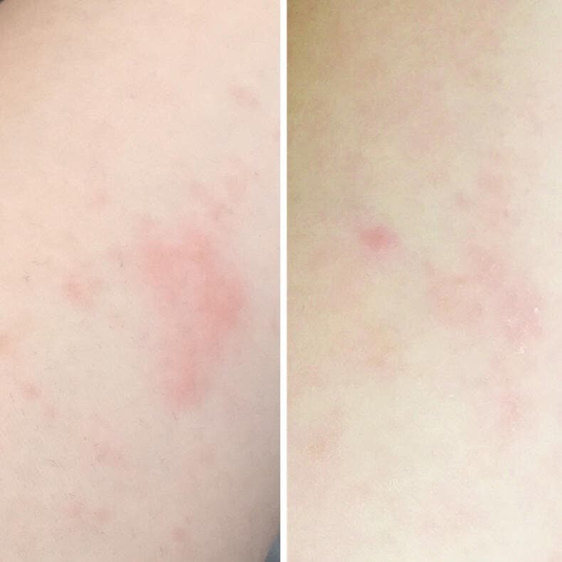 贝亲桃子水祛痱子,儿童痱子水测评