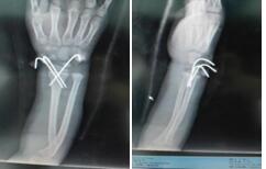 骨骺损伤手术修复后能恢复正常吗,儿童骨骺损伤手法复位