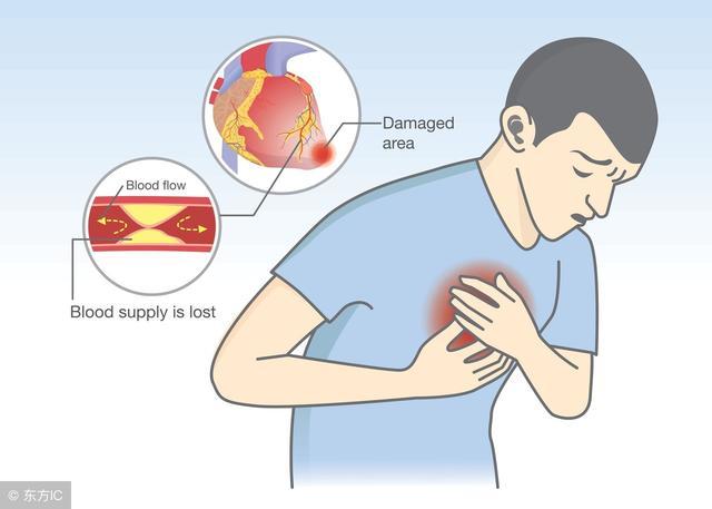 心肌梗死病人日常饮食有哪些需要,侧壁心肌梗死日常饮食需要注意