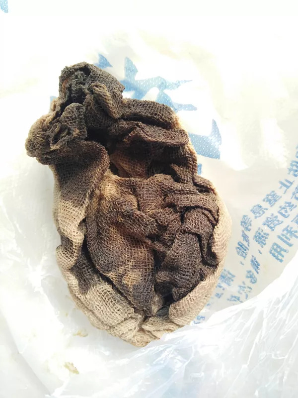 流产手术后三天忽然腹痛,人流后四天肚子痛排出血块