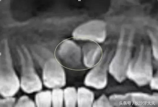 孩子门牙多生牙拔了之后牙缝很大,8岁男童多生牙门牙缝隙大