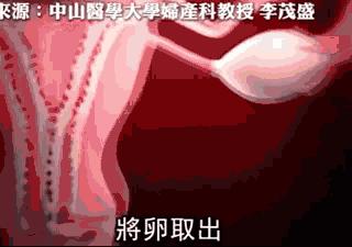 卖卵女孩：“我用二十颗卵子换了一台iPhoneX”