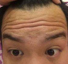 抬头纹多又深警惕心血管疾病,抬头纹特别深怎么办