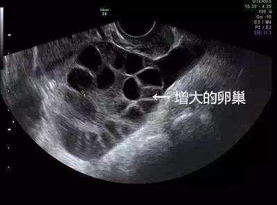 21颗卵卖10000元，17岁少女险丢命！女人一生多少卵子？长点心吧