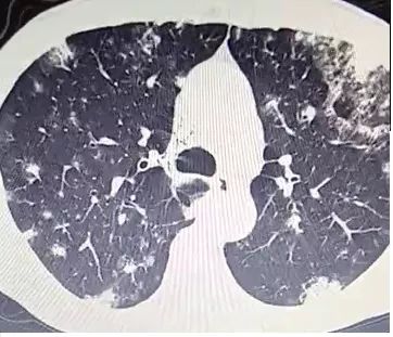 每日咳嗽是什么原因,每日咳痰