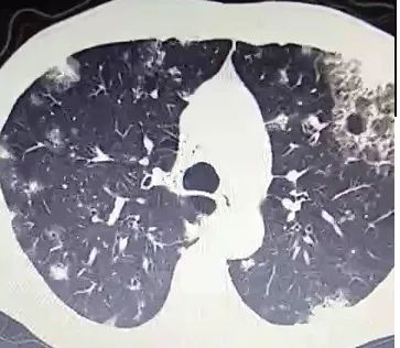 每日咳嗽是什么原因,每日咳痰