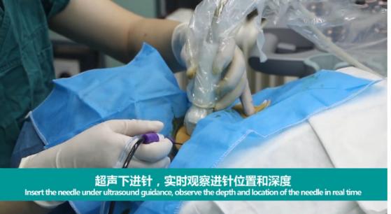 微波消融术，让甲状腺患者康复“加速度”