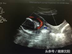 胎儿血管前置如何预防,孕妈课堂新生儿疾病筛查解读