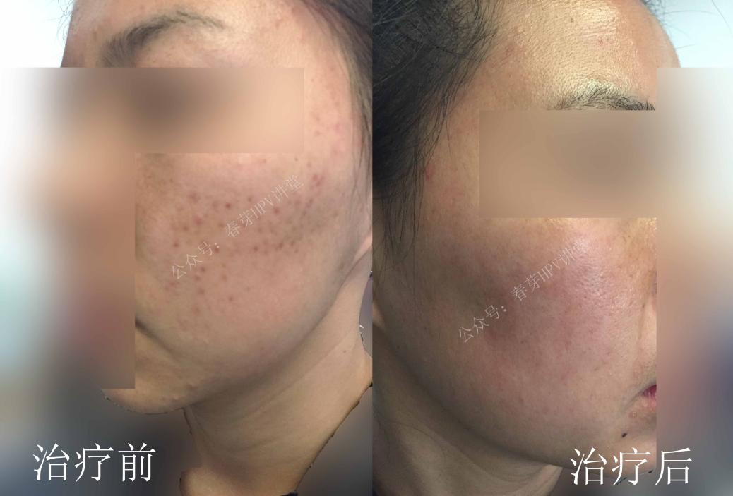 30多岁还起痤疮怎么回事,三十多岁脸上一直长痤疮什么原因