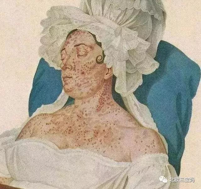 儿童急疹科普,宝宝湿疹和热疹的正确护理方法