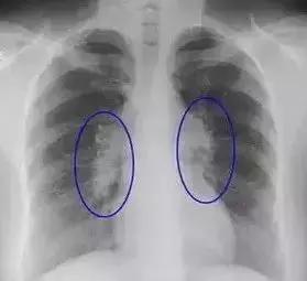 结节息肉囊肿缠身老中医教你一招,中医调理结节囊肿息肉体质