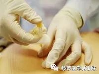 「杏林微科普」带您了解：中医穴位埋线