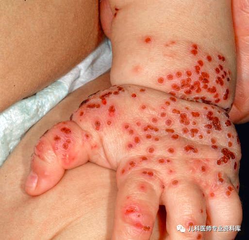 宝宝嘴巴上火了擦什么药膏好,嘴巴上火一圈红怎么办