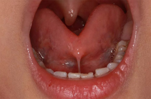 9岁孩子舌系带过短发音不准,孩子说话不清楚是舌系带过短吗