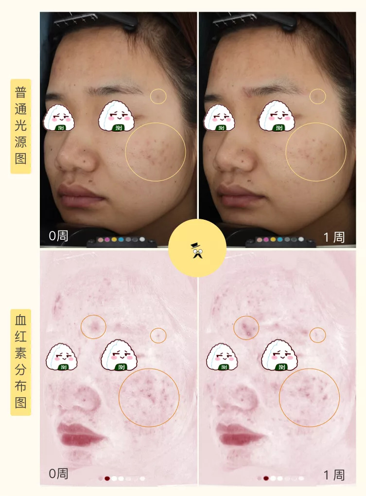 30天花80块去掉陈年老痘印到底有没有可能？