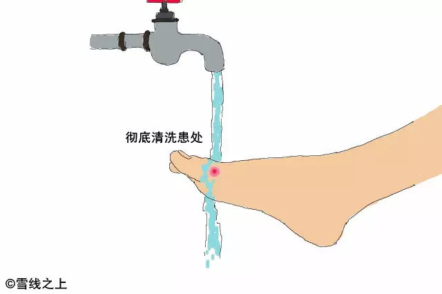陶冶重庆｜徒步时，如何防治水泡？