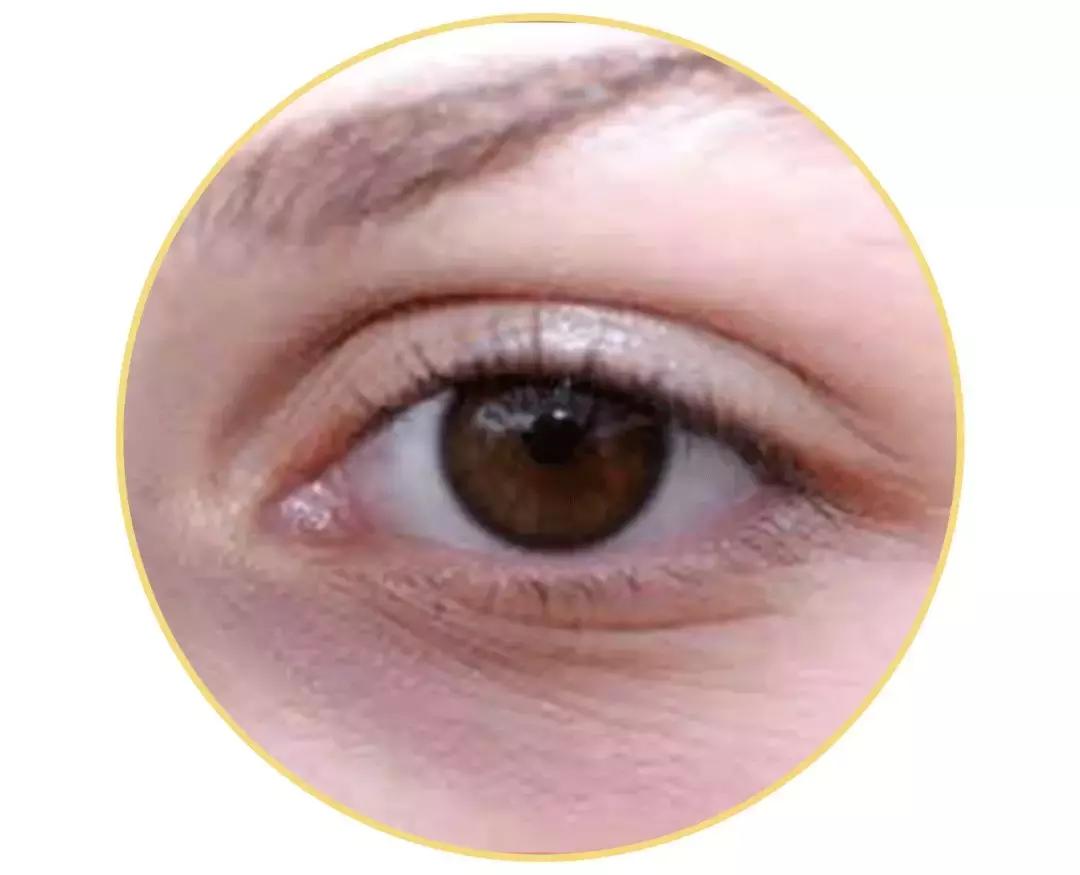 解决黑眼圈细纹最有效的方法,黑眼圈细纹比较严重怎么办