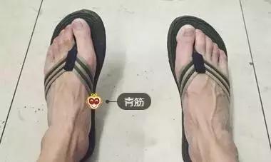 警惕肝脏的5个征兆,肝青筋