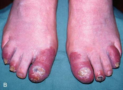 世界银屑病日银屑病关节炎,银屑病关节炎是银屑病后期吗